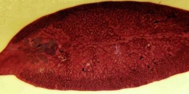 parazit motolice ako odstrániť z tela